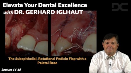 The subepithelial, rotational pedicle flap with a palatal base